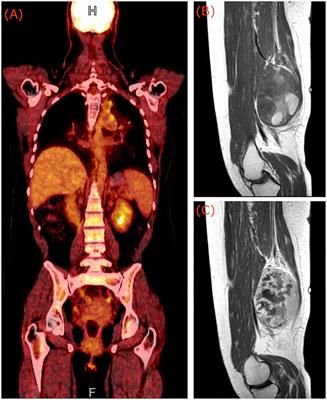 Case report: skeletal muscle metastasis from follicular thyroid carcinoma presenting as synovial sarcoma